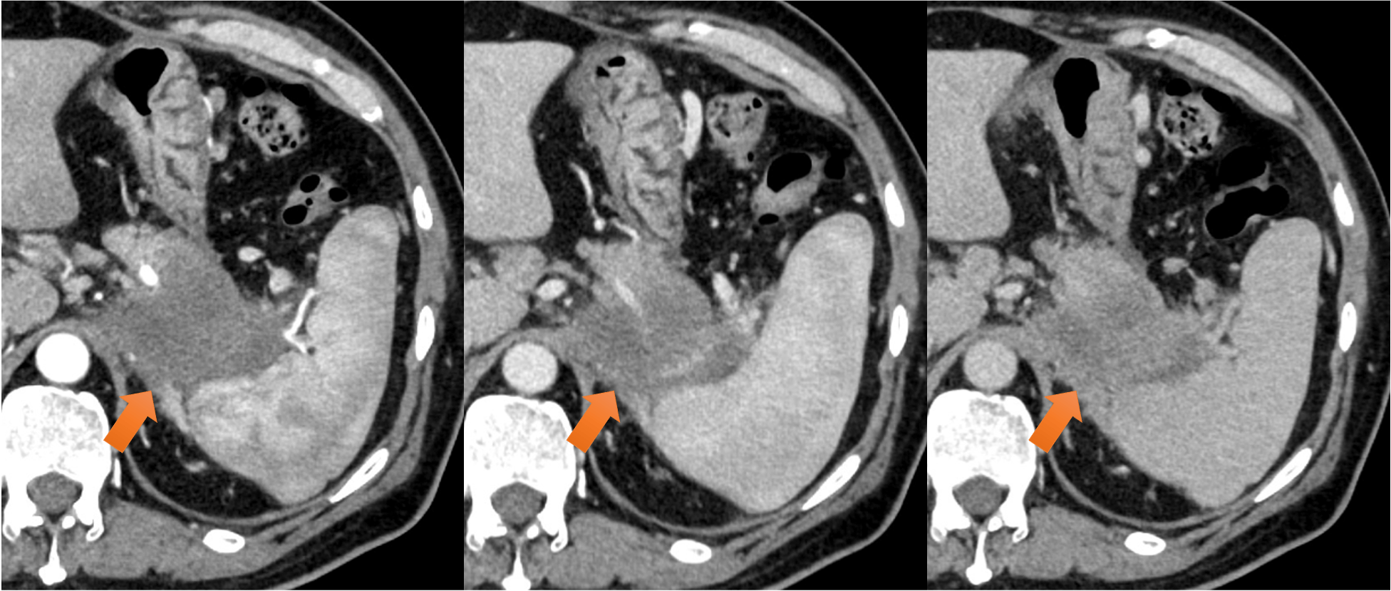 図1．膵尾部腫瘤（66mm）