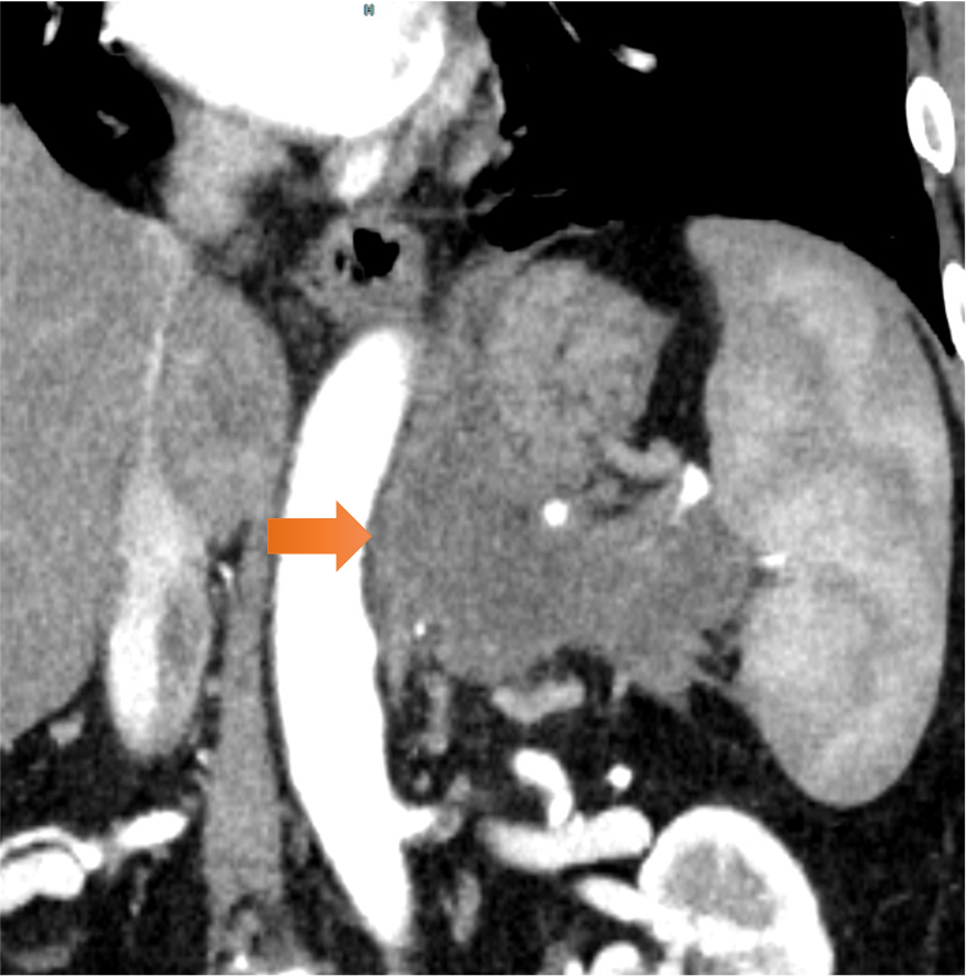 図2．周辺臓器浸潤