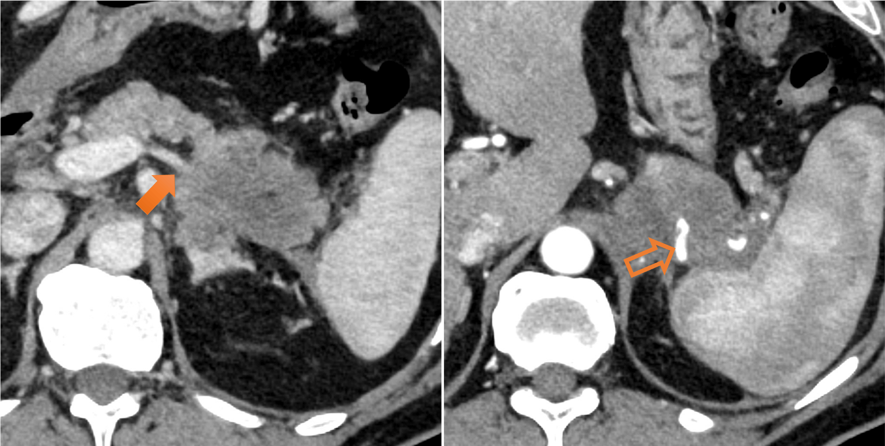 図3．脾動静脈浸潤