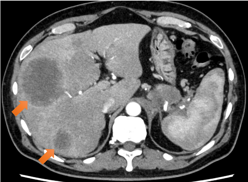 図4．多発肝転移