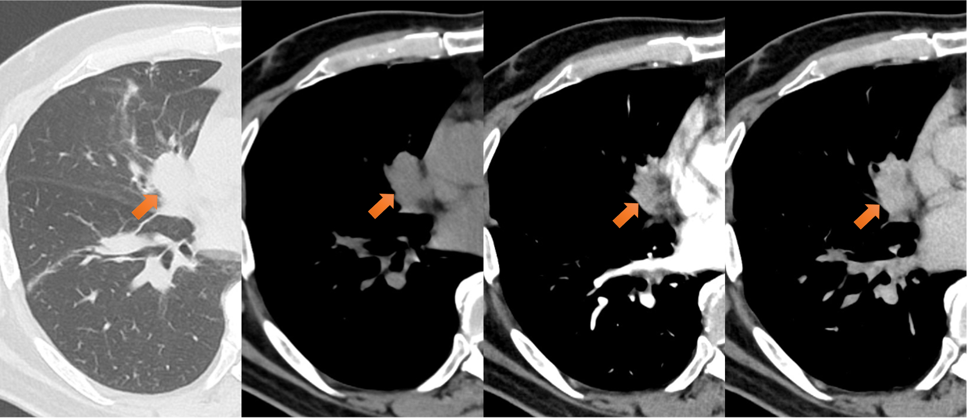 図5．右中葉腫瘤