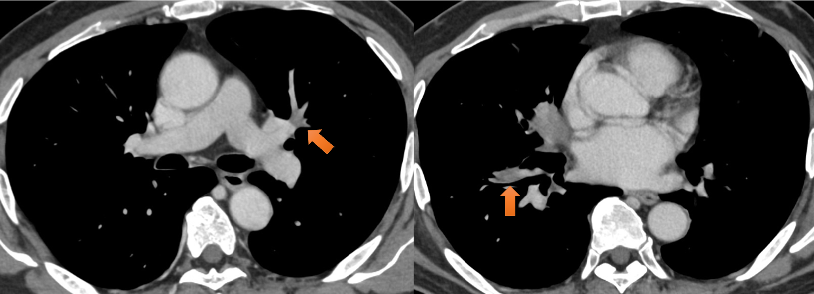 図6．肺動脈造影欠損像