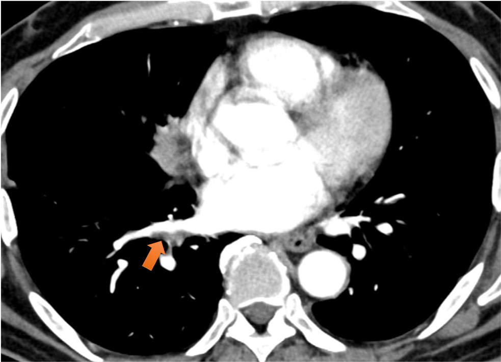 図7．肺静脈造影欠損像