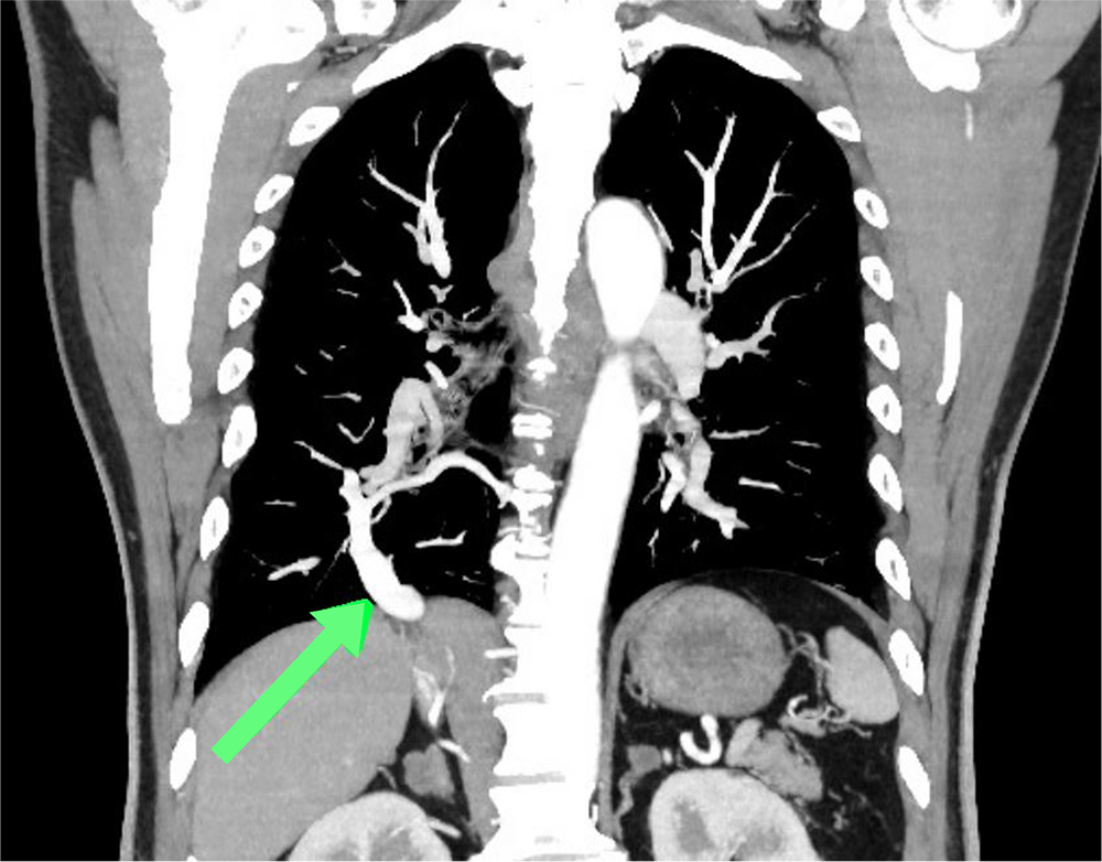 図1．造影CT（動脈相）冠状断MIP像