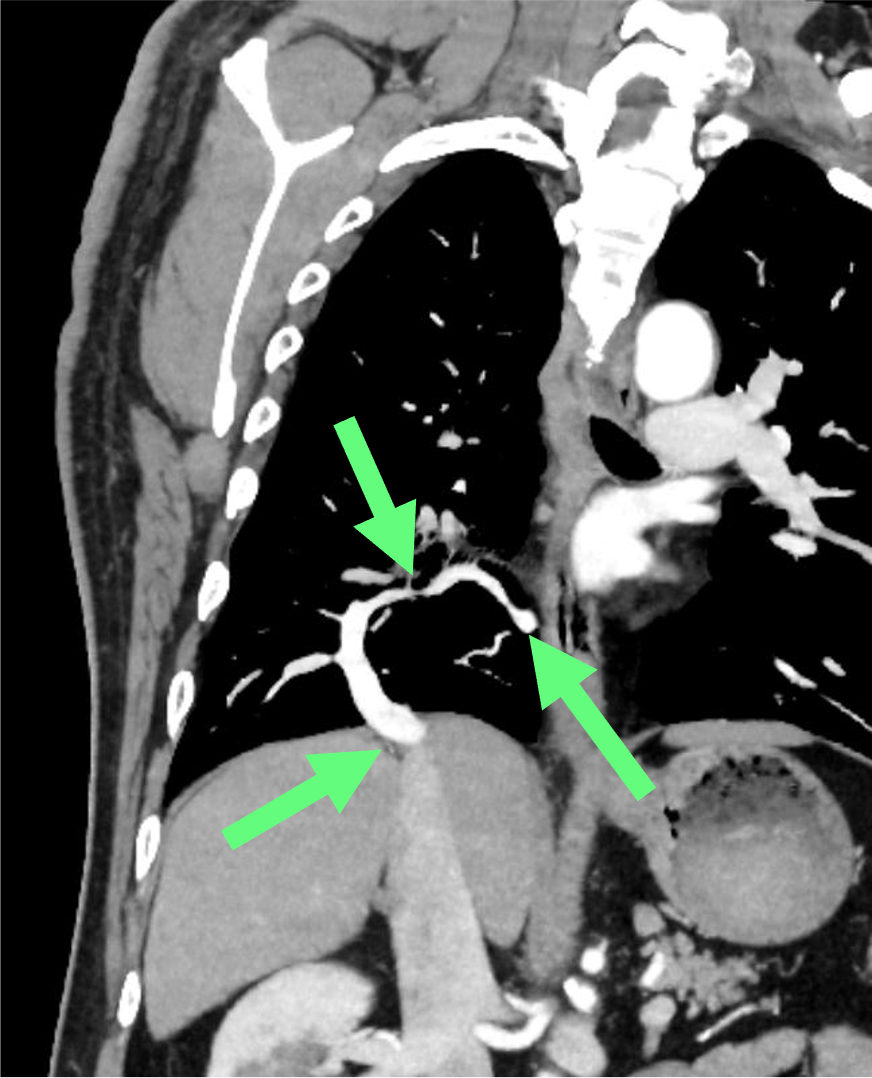 図2．造影CT（動脈相）冠状断MIP像