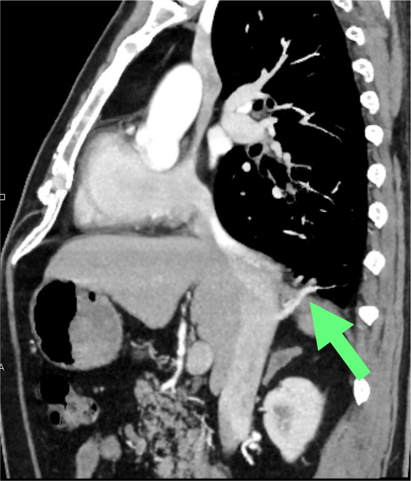 図5．造影CT（動脈相）矢状断MIP像
