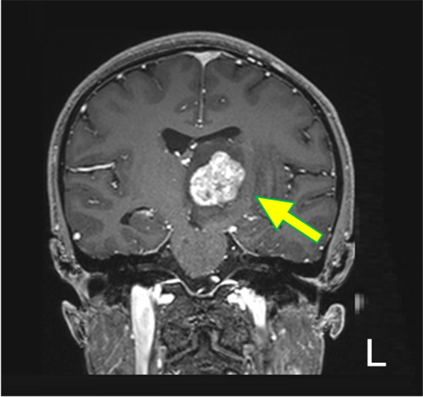 図6．造影後　T1WI (Cor.)