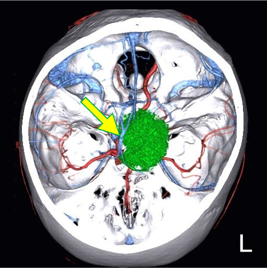 図7．造影後T1WI、4D-CTAngiographyのFusion像