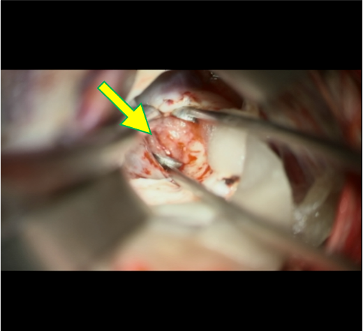 図8．生検時の術中写真