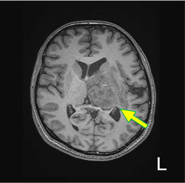 図１．T1WI（Tra.）