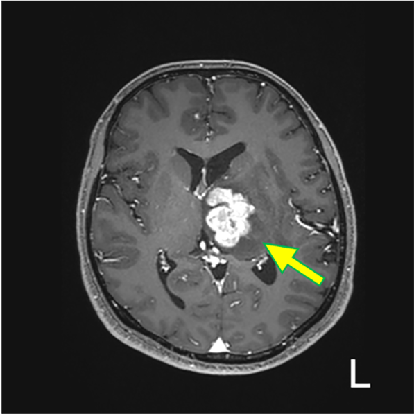 図5．造影後　T1WI (Tra.)