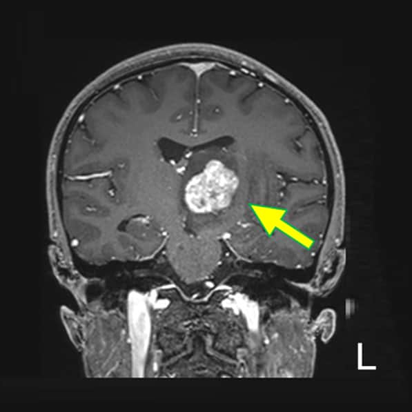 図6．造影後　T1WI (Cor.)