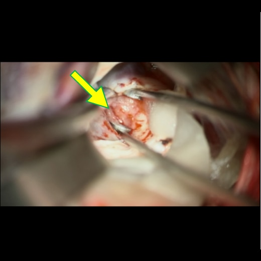 図8．生検時の術中写真