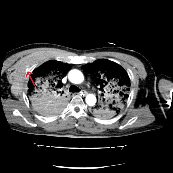図2．早期動脈相