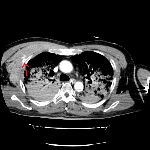 図3．後期動脈相