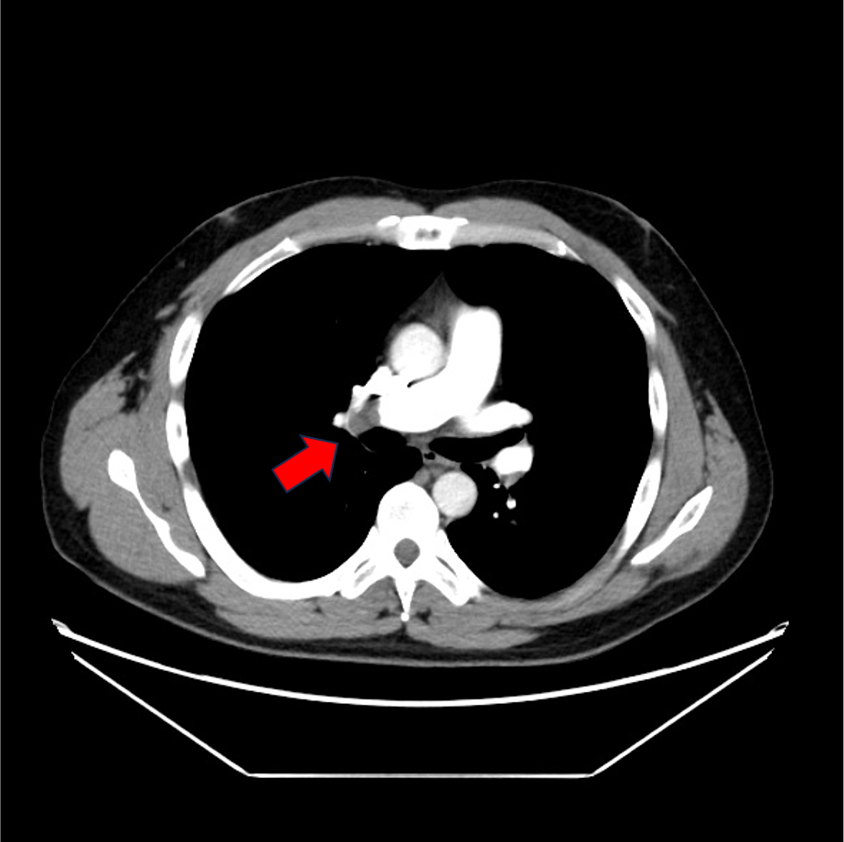 図1．肺動脈相(70keV)