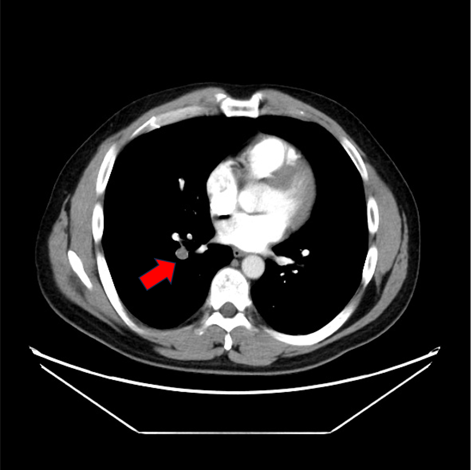図2．肺動脈相(70keV)