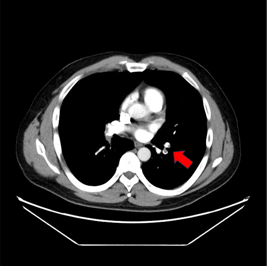 図3．肺動脈相(70keV)