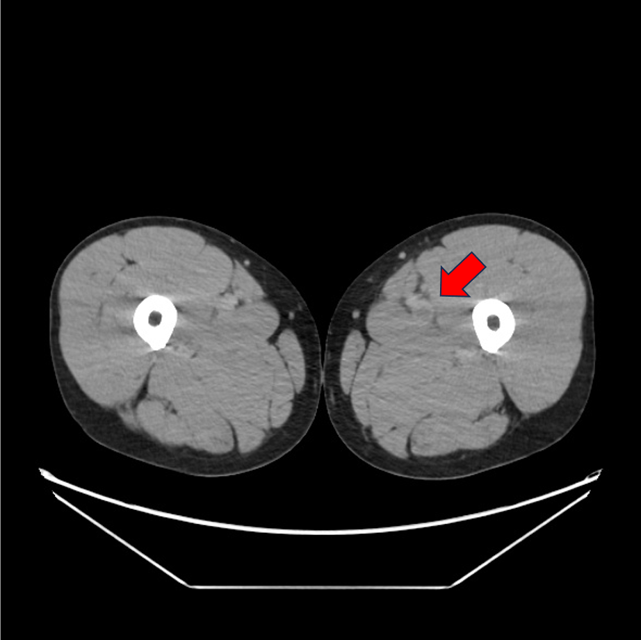 図4．静脈相(50keV)