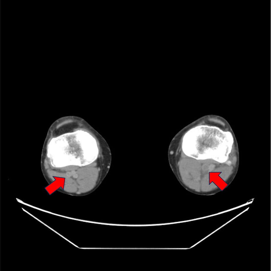 図5．静脈相(50keV)