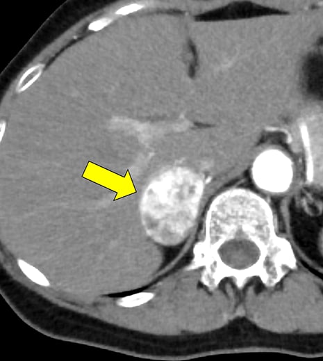 図2．冠動脈CT　axial 像