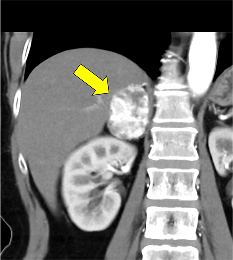 図3．冠動脈CT　axial 像