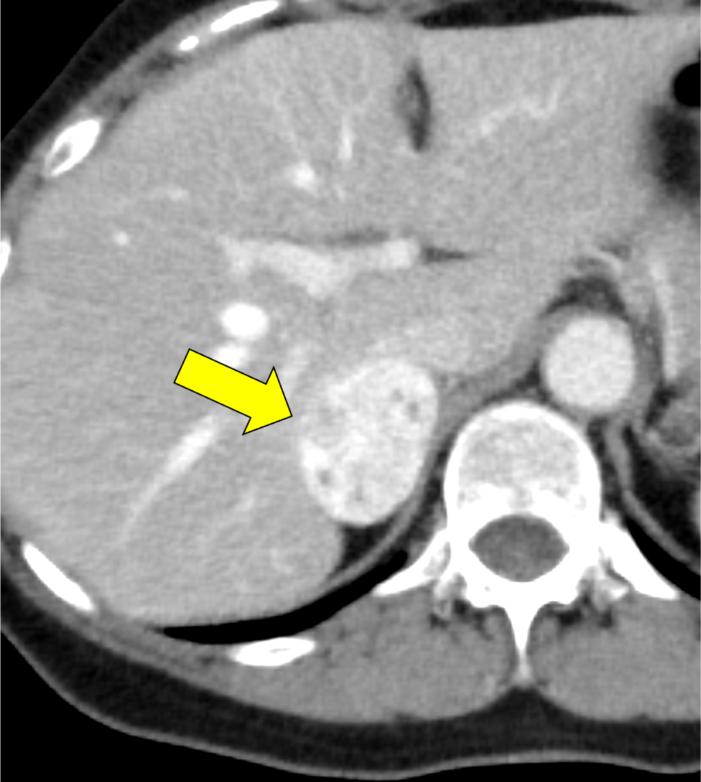 図4．冠動脈CT　axial 像