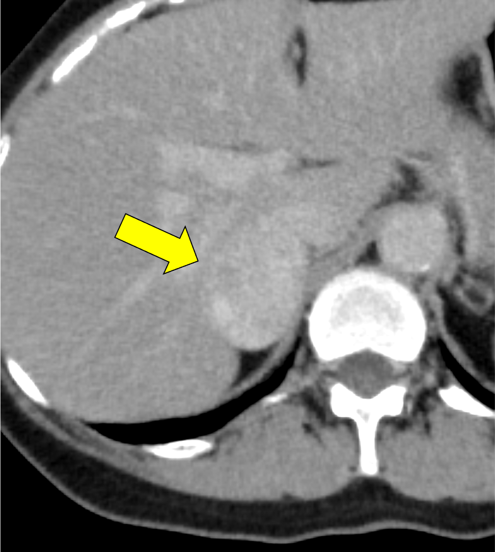図5．冠動脈CT　axial 像