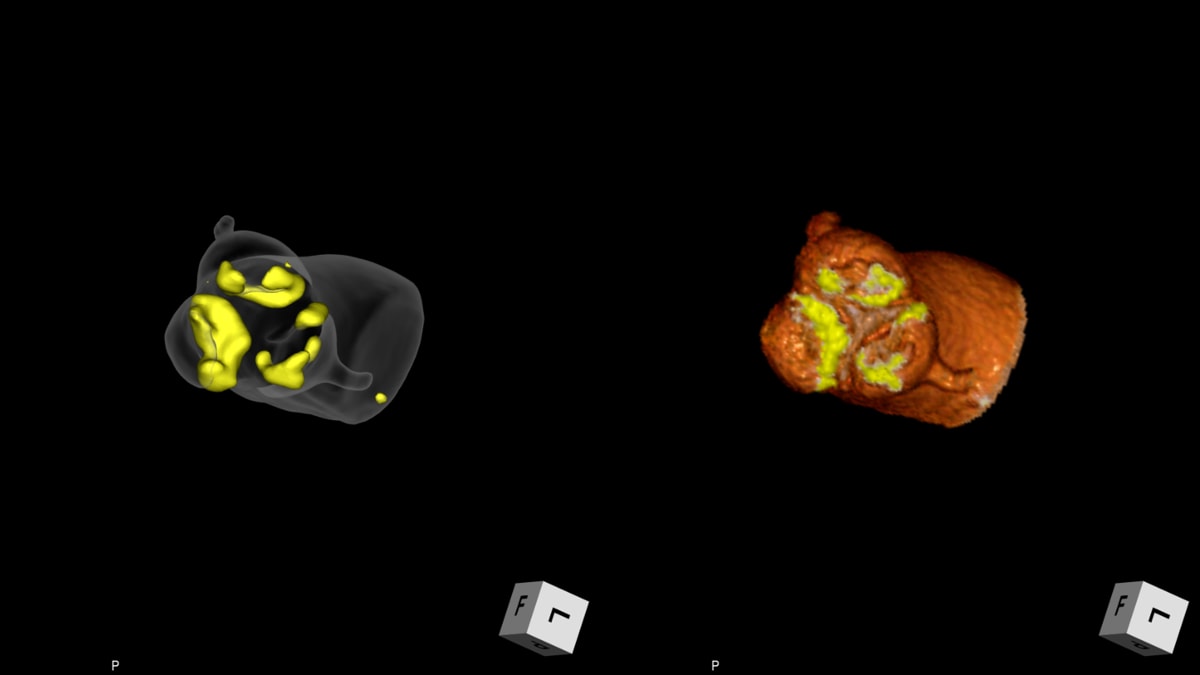 図3．大動脈弁周囲のvolume-rendering technique (VRT) 画像