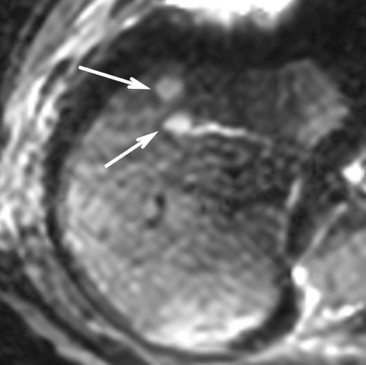 図2．拡散強調画像（b = 800 s/mm²）