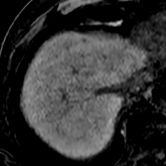 図3．脂肪抑制併用T1強調画像（造影前）