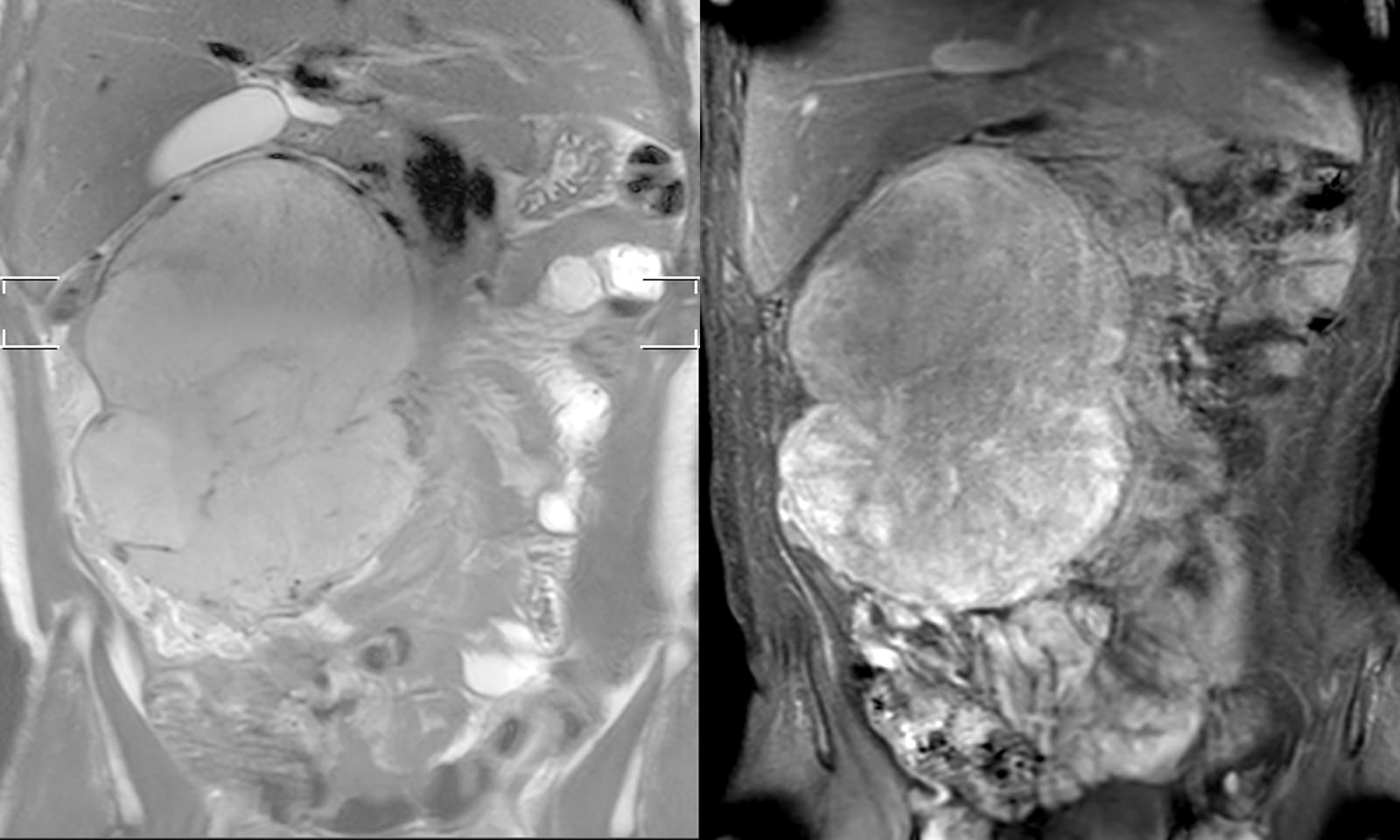 図3．Coronal Image (左: T2強調像, 右: 造影T1強調像)