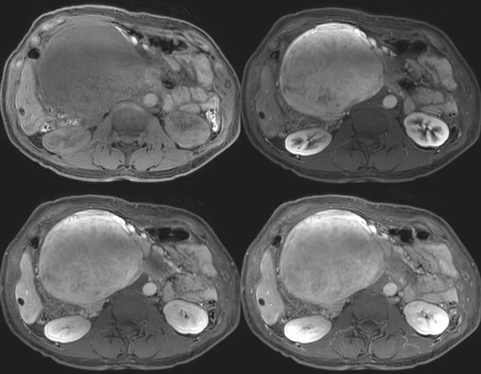 図5．造影dynamic MRI (左上: 造影剤投与前, 右上: 30秒後, 左下: 70秒後, 右下: 180秒後)